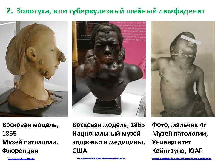 2. Золотуха, или туберкулезный шейный лимфаденит Восковая модель, 1865 Музей патологии, Флоренция http: //tuscantraveler.