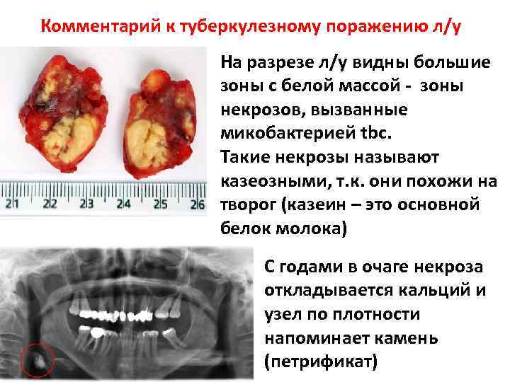 Комментарий к туберкулезному поражению л/у На разрезе л/у видны большие зоны с белой массой