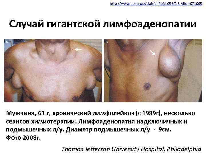 http: //www. nejm. org/doi/full/10. 1056/NEJMicm 071065 Случай гигантской лимфоаденопатии Мужчина, 61 г, хронический лимфолейкоз