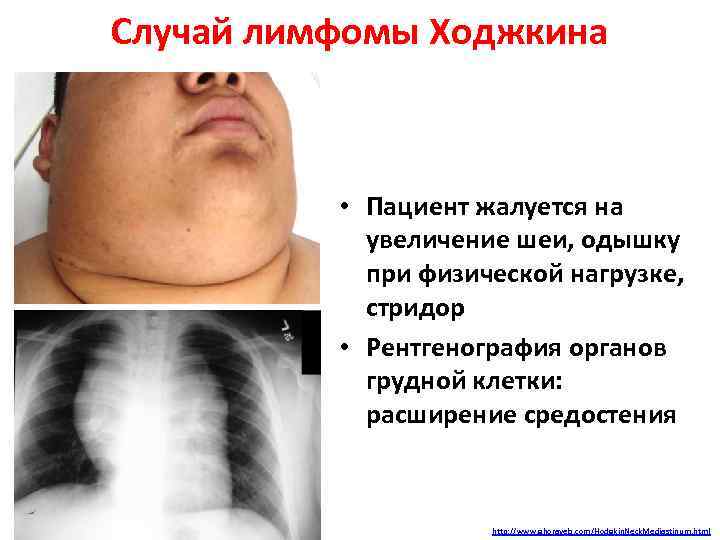 Случай лимфомы Ходжкина • Пациент жалуется на увеличение шеи, одышку при физической нагрузке, стридор