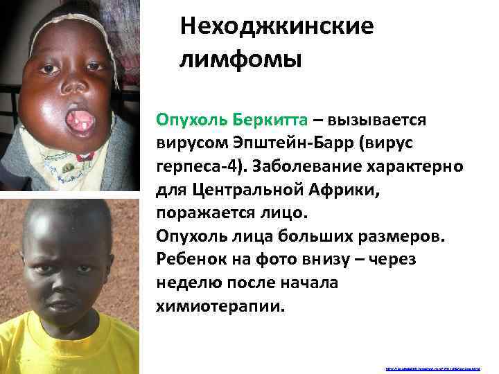 Неходжкинские лимфомы Опухоль Беркитта – вызывается вирусом Эпштейн-Барр (вирус герпеса-4). Заболевание характерно для Центральной