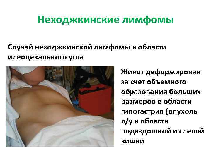 Неходжкинские лимфомы Случай неходжкинской лимфомы в области илеоцекального угла Живот деформирован за счет объемного