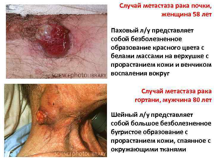 Случай метастаза рака почки, женщина 58 лет Паховый л/у представляет собой безболезненное образование красного