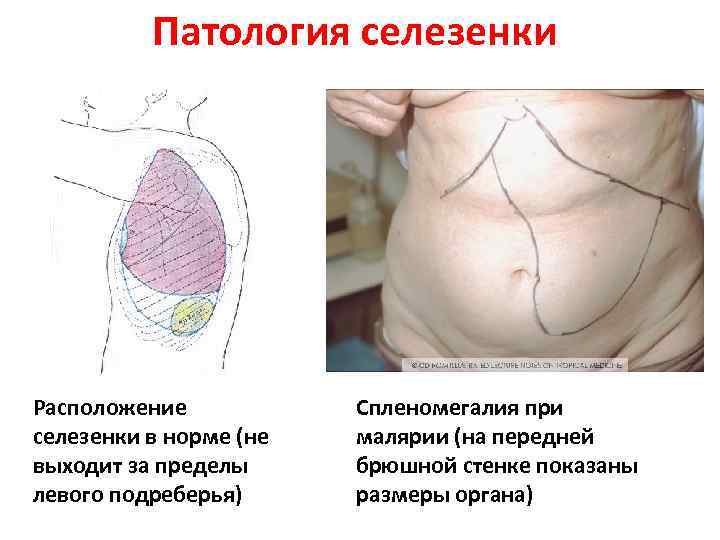 Патология селезенки Расположение селезенки в норме (не выходит за пределы левого подреберья) Спленомегалия при
