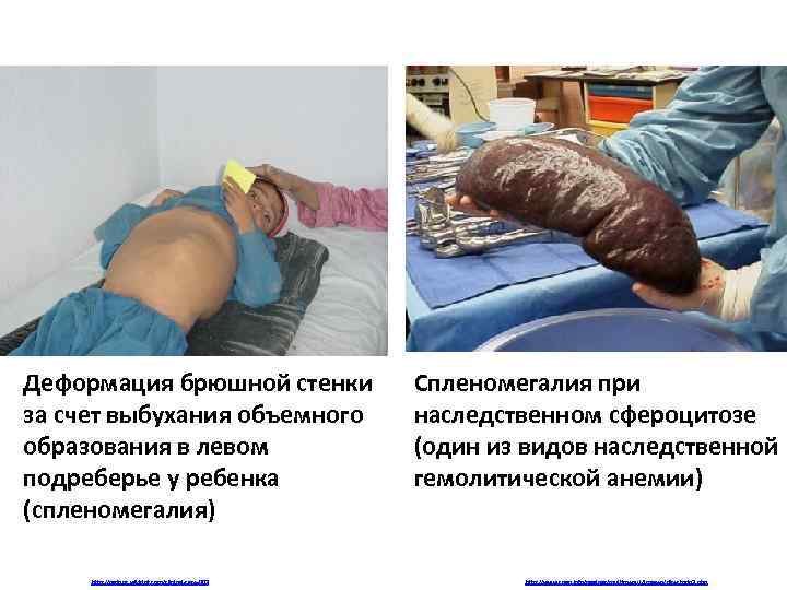 Деформация брюшной стенки за счет выбухания объемного образования в левом подреберье у ребенка (спленомегалия)