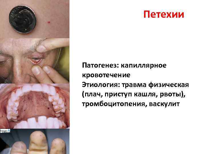 Петехии Патогенез: капиллярное кровотечение Этиология: травма физическая (плач, приступ кашля, рвоты), тромбоцитопения, васкулит 