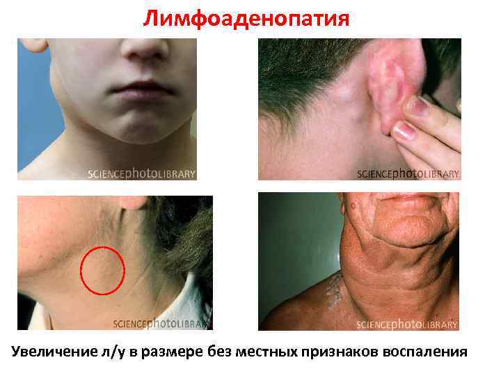 Лимфоаденопатия Увеличение л/у в размере без местных признаков воспаления 