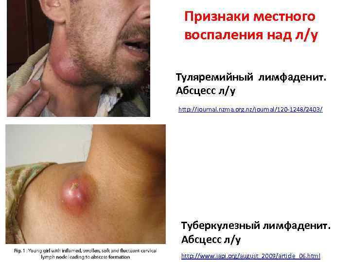 Признаки местного воспаления над л/у Туляремийный лимфаденит. Абсцесс л/у http: //journal. nzma. org. nz/journal/120
