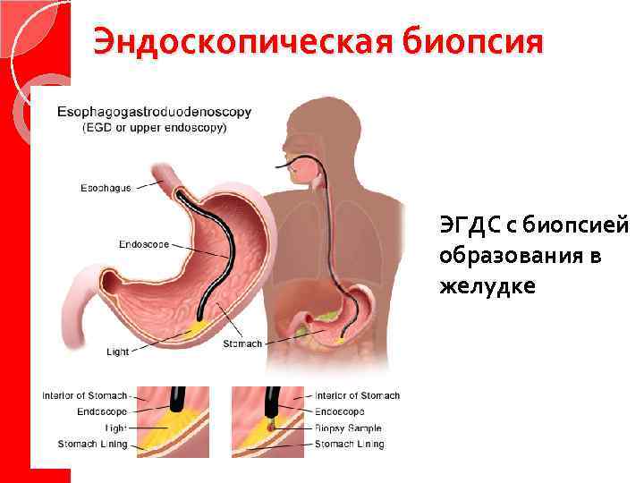 Биопсия желудка