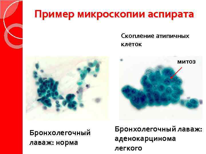 Пример микроскопии аспирата Скопление атипичных клеток митоз Бронхолегочный лаваж: норма Бронхолегочный лаваж: аденокарцинома легкого