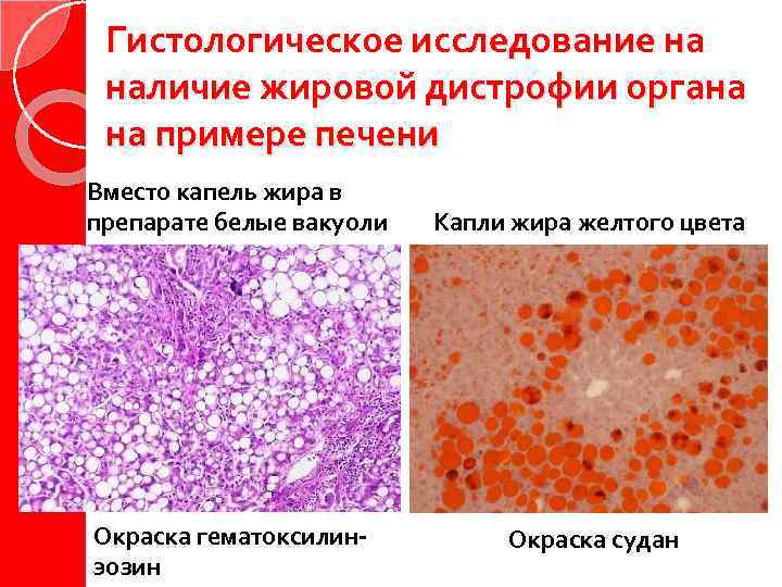 Рисунок жировой дистрофии печени