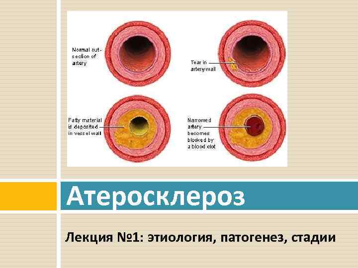 Патанатомия атеросклероз презентация