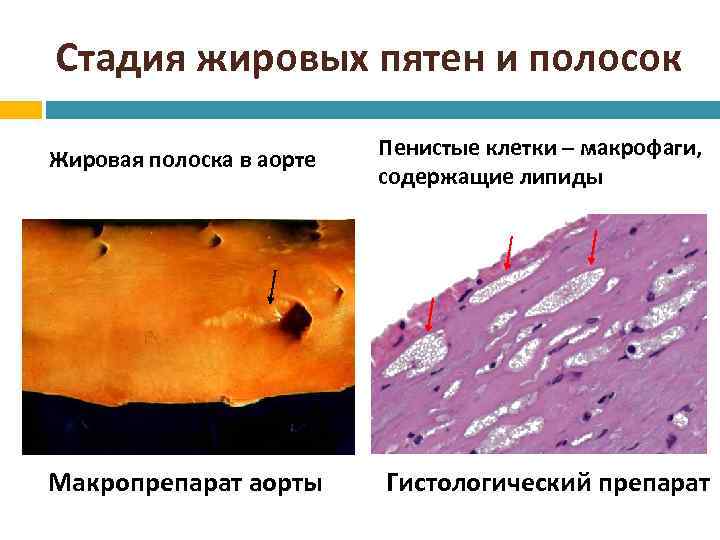 Атеросклероз патанатомия презентация