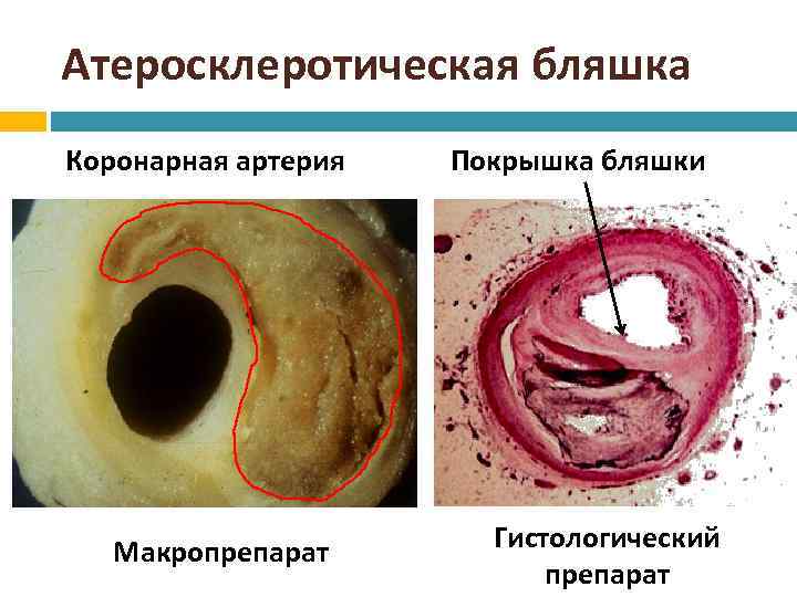 Фото атеросклеротические бляшки