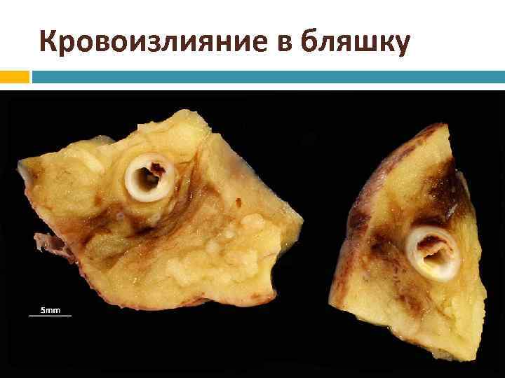 Кровоизлияние в бляшку 