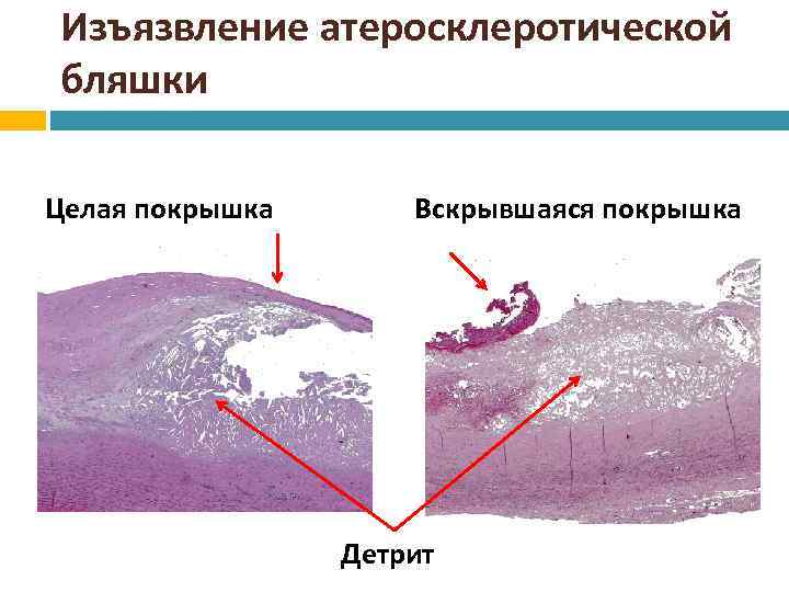 Морфологическая картина атеросклероза стабильная и нестабильная атеросклеротическая бляшка