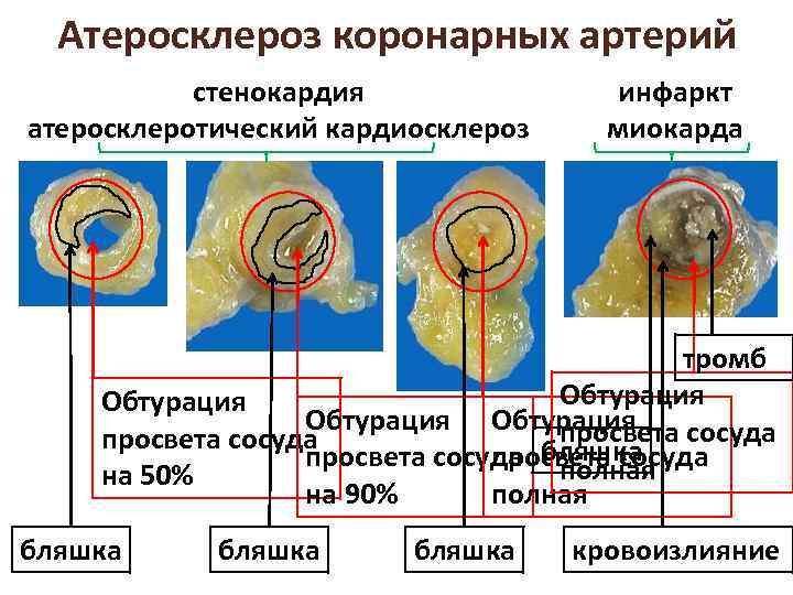 Атеросклероз коронарных артерий стенокардия атеросклеротический кардиосклероз инфаркт миокарда тромб Обтурация просвета сосуда бляшка просвета