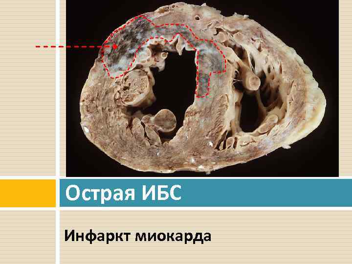 Острая ИБС Инфаркт миокарда 