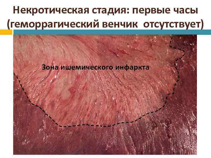 Некротическая стадия: первые часы (геморрагический венчик отсутствует) Зона ишемического инфаркта 
