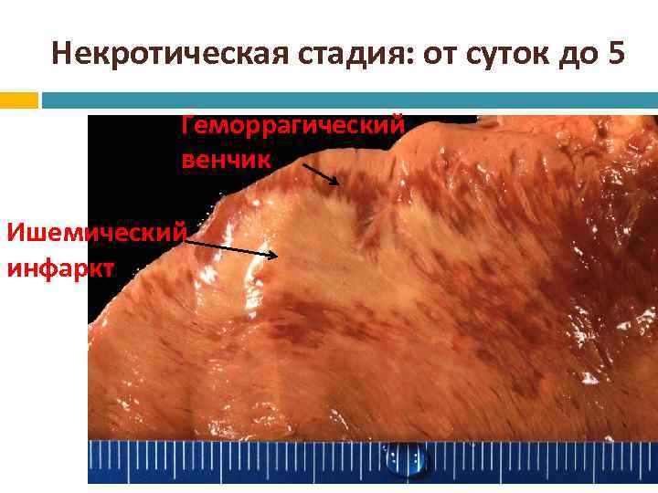 Некротическая стадия: от суток до 5 Геморрагический венчик Ишемический инфаркт 