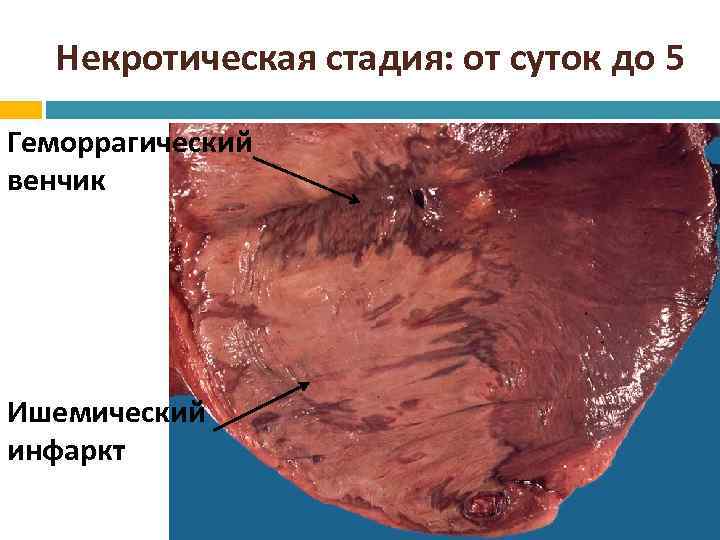 Некротическая стадия: от суток до 5 Геморрагический венчик Ишемический инфаркт 