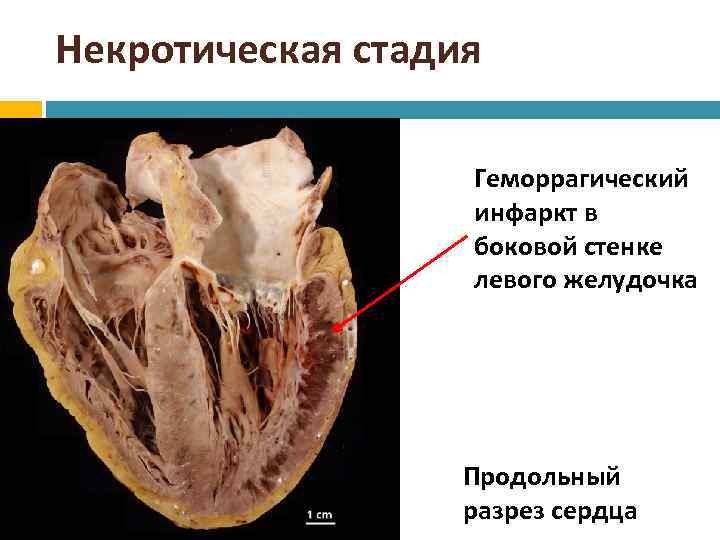 Некротическая стадия Геморрагический инфаркт в боковой стенке левого желудочка Продольный разрез сердца 