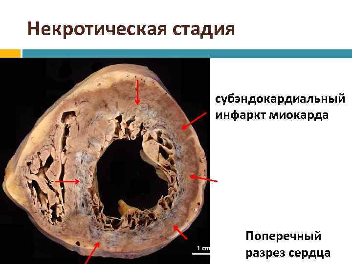 Субэндокардиальная ишемия на экг фото