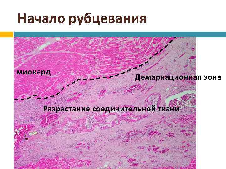 Начало рубцевания миокард Демаркационная зона Разрастание соединительной ткани 
