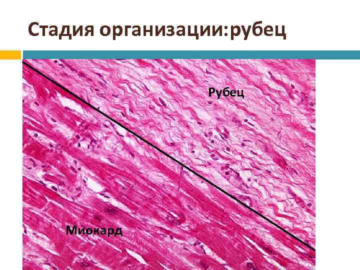 Стадия организации: рубец Рубец Миокард 