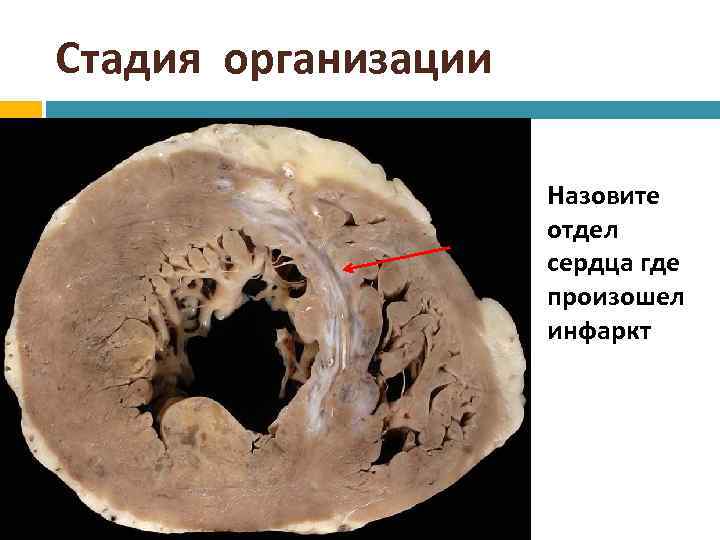 Стадия организации Назовите отдел сердца где произошел инфаркт 