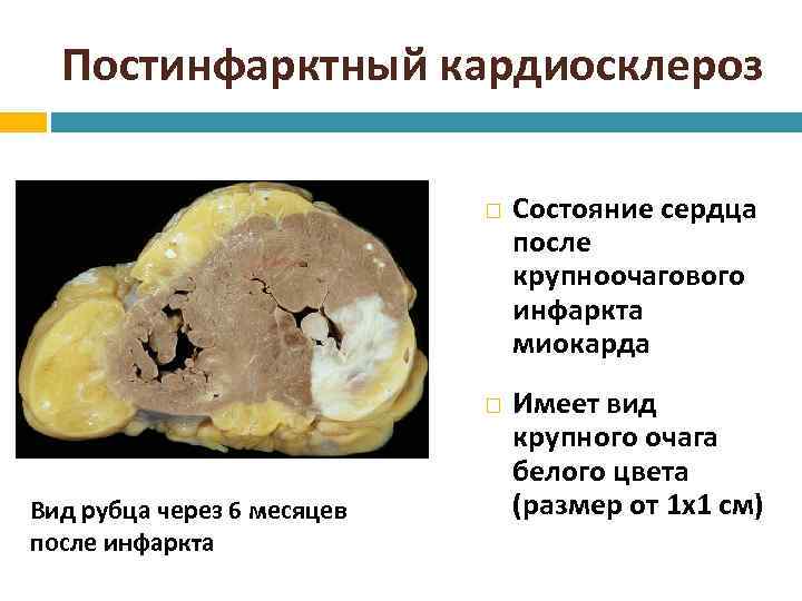 Постинфарктный кардиосклероз карта вызова