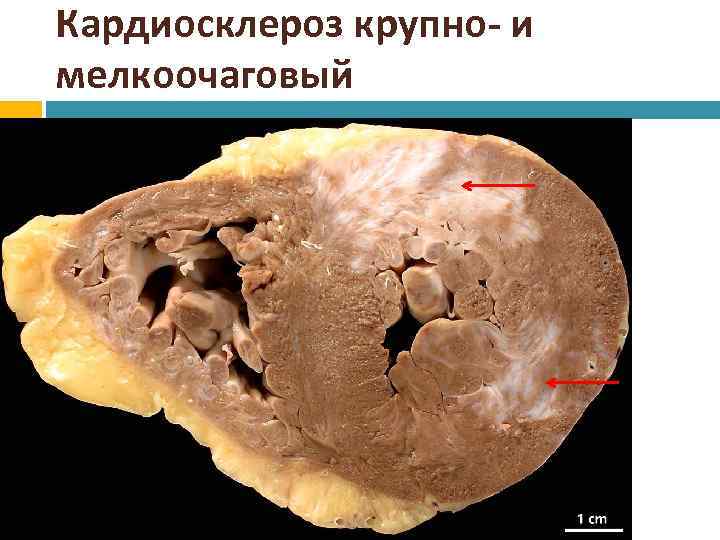 Кардиосклероз крупно- и мелкоочаговый 