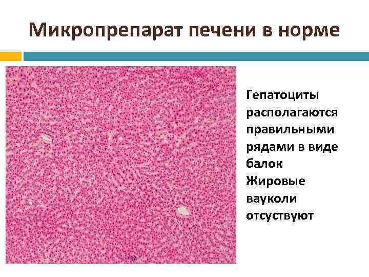 Цирроз печени микропрепарат рисунок