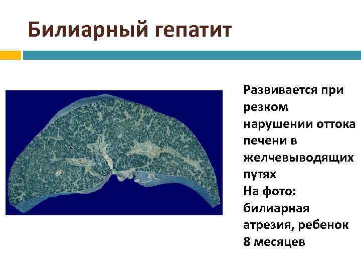 Билиарный гепатит Развивается при резком нарушении оттока печени в желчевыводящих путях На фото: билиарная