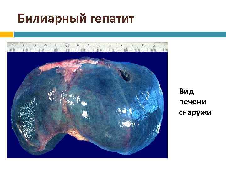 Билиарный гепатит Вид печени снаружи 