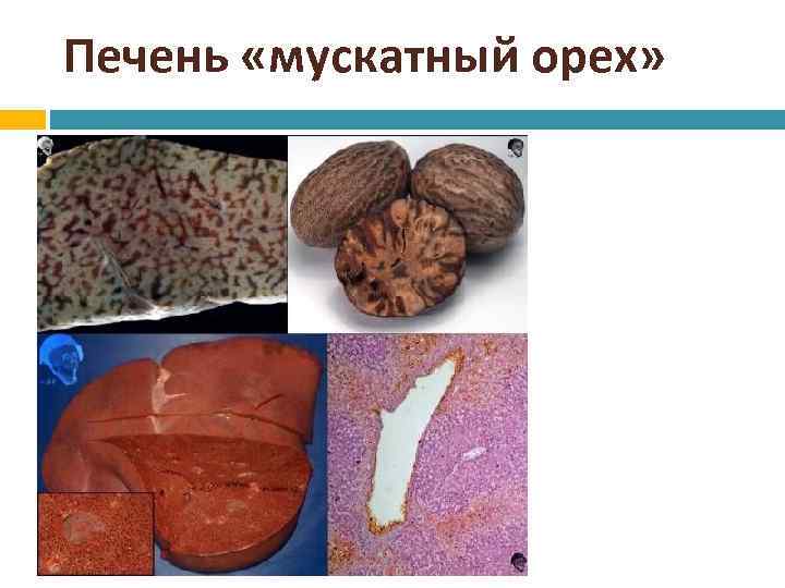 Печень «мускатный орех» 