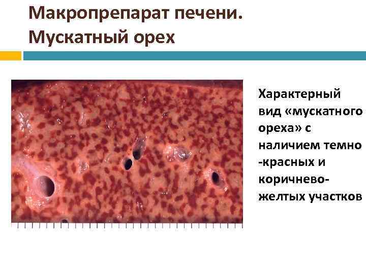 Мускатная печень. Мускатный цирроз печени макропрепарат. Мускатная печень макропреп. Ма ропрепарат мускатноц печени. Мускатная печень макропрепарат описание.