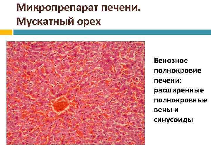 Хроническое полнокровие печени. Венозное полнокровие печени мускатная печень микропрепарат. Венозное полнокровие печени микропрепарат. Хроническое венозное полнокровие микропрепарат. Мускатный цирроз печени микропрепарат.