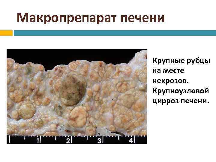 Макропрепарат печени Крупные рубцы на месте некрозов. Крупноузловой цирроз печени. 
