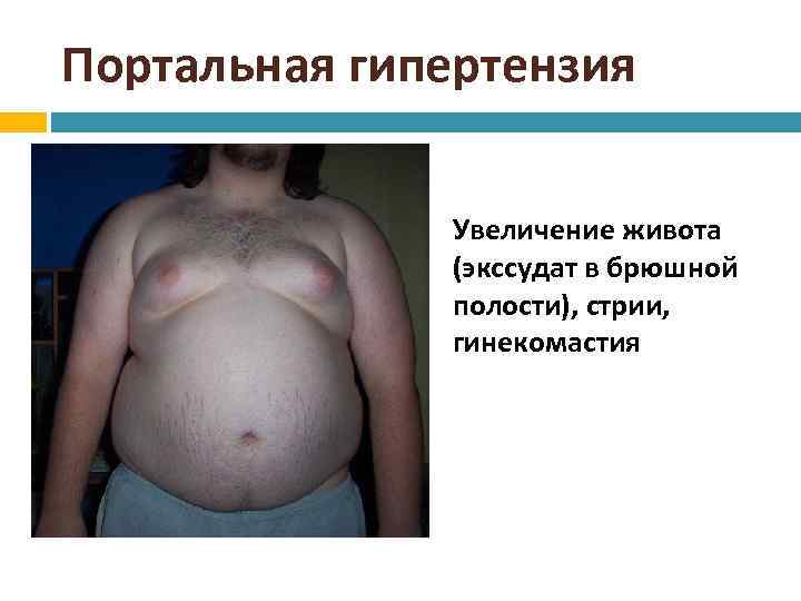 Портальная гипертензия Увеличение живота (экссудат в брюшной полости), стрии, гинекомастия 