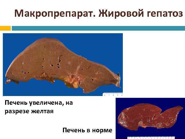 Макропрепарат. Жировой гепатоз Печень увеличена, на разрезе желтая Печень в норме 
