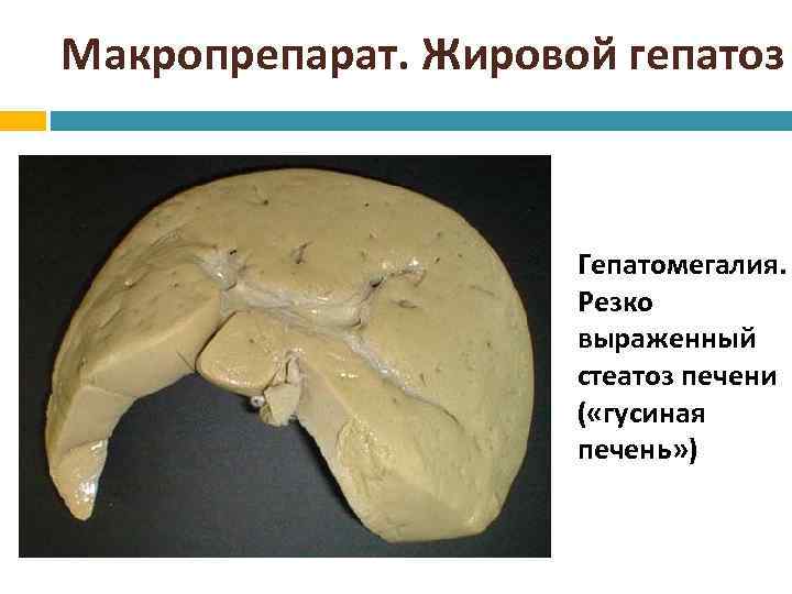 Макропрепарат. Жировой гепатоз Гепатомегалия. Резко выраженный стеатоз печени ( «гусиная печень» ) 