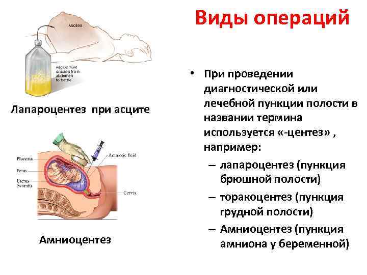 Операция лапароцентез