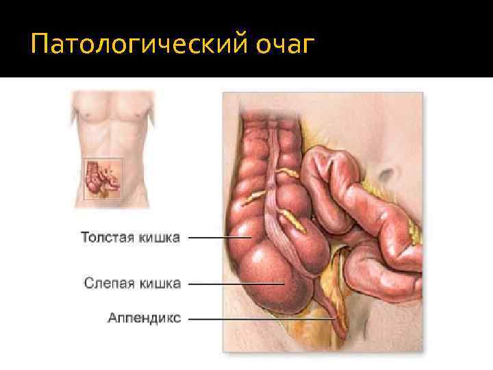 Патологический очаг 