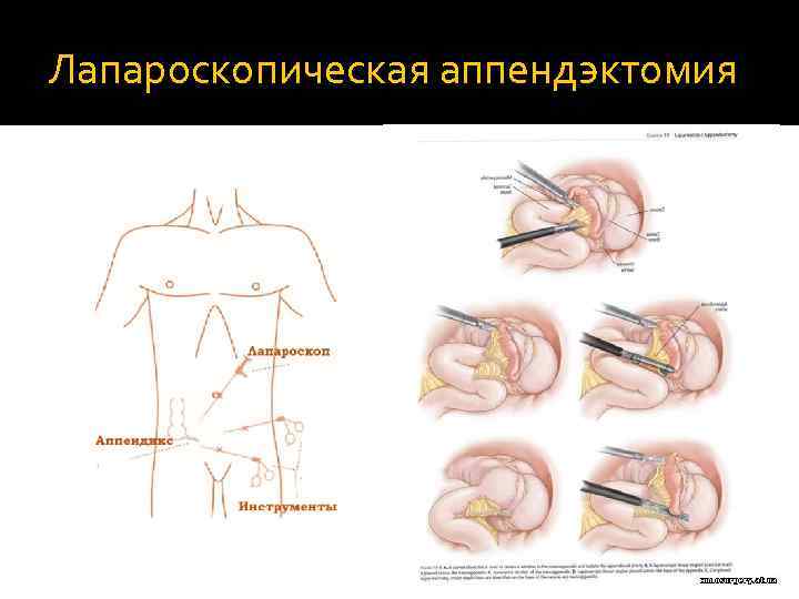 Лапароскопическая аппендэктомия 