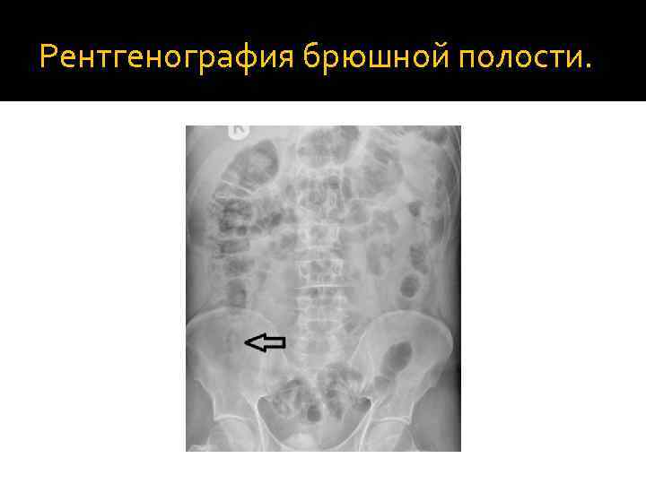 Рентгенография брюшной полости. 