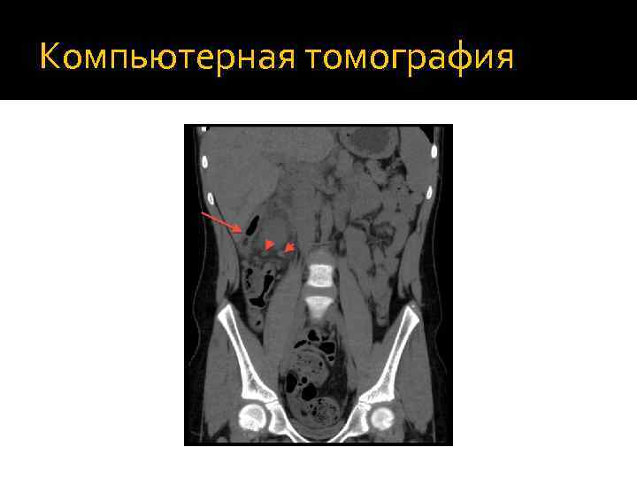 Аппендикулярный инфильтрат. Аппендикулярный инфильтрат мрт. Компьютерная томография острого аппендицита. Аппендикулярный абсцесс кт.