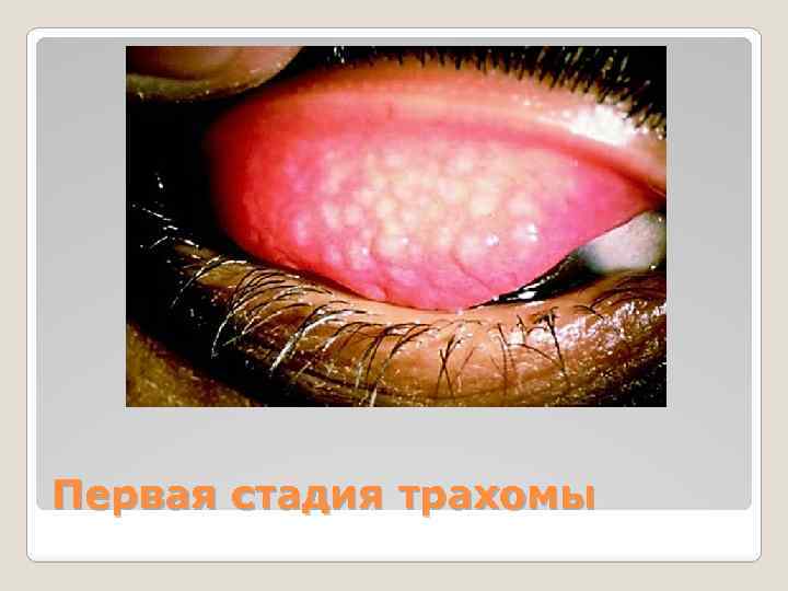 Первая стадия трахомы 