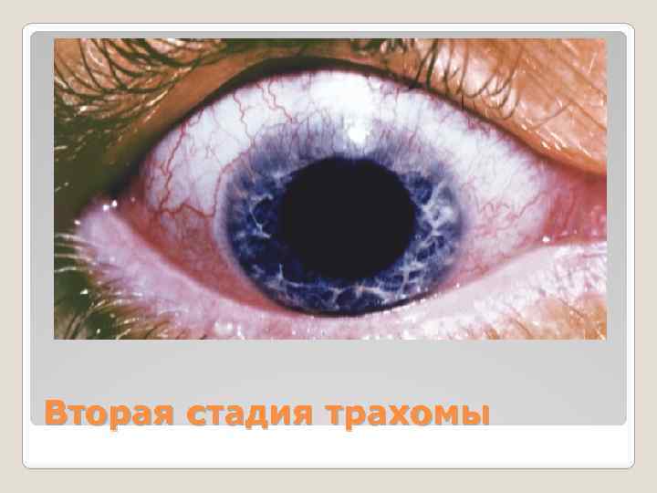 Вторая стадия трахомы 