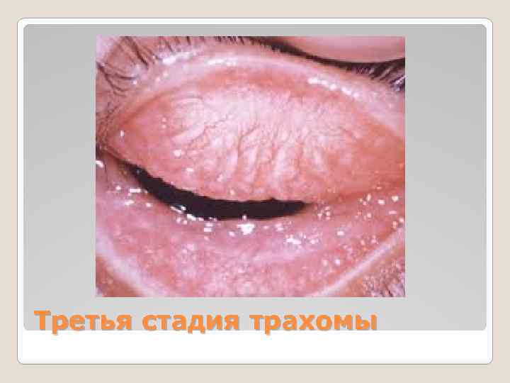 Третья стадия трахомы 